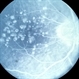 Unknown maculopathy, fluorescein Unknown maculopathy, fluorescein